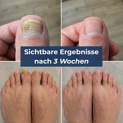 Levora - MedNail gegen jahrelangen Nagelpilz