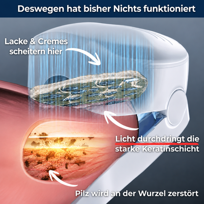 Levora - MedNail gegen jahrelangen Nagelpilz