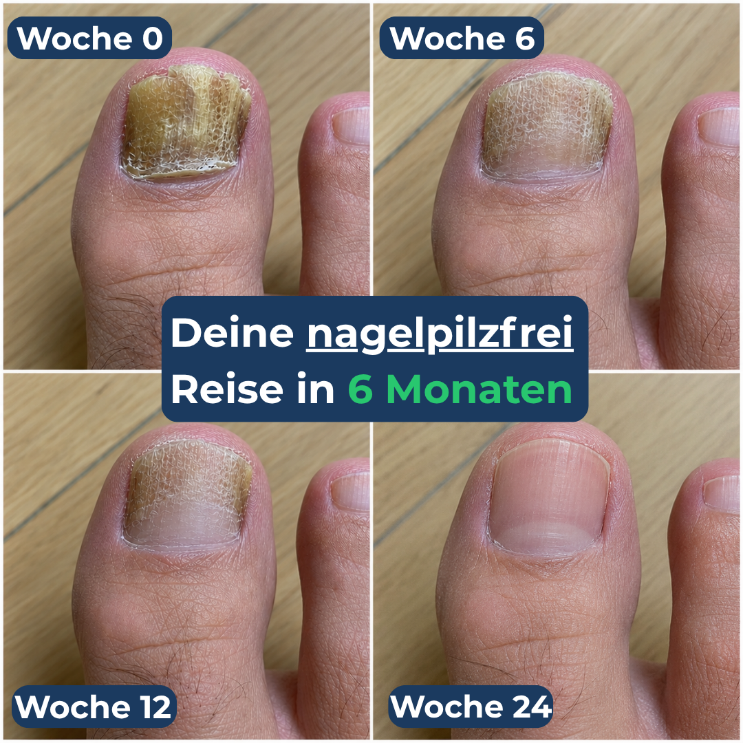 Levora - MedNail gegen jahrelangen Nagelpilz